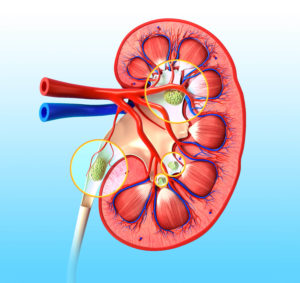 illustration of kidney stone section photography